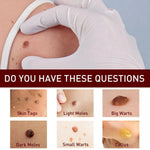 Warts Remover