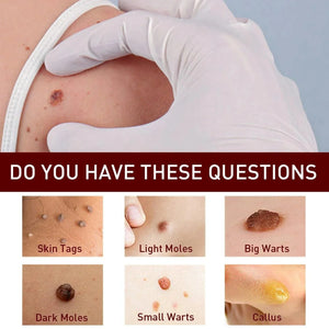 Warts Remover